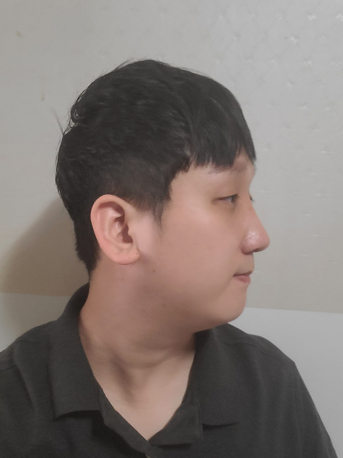 수술후기이미지