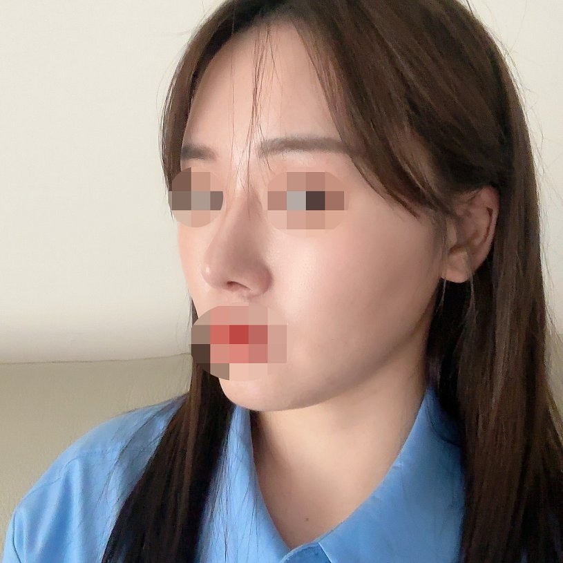 수술후기이미지