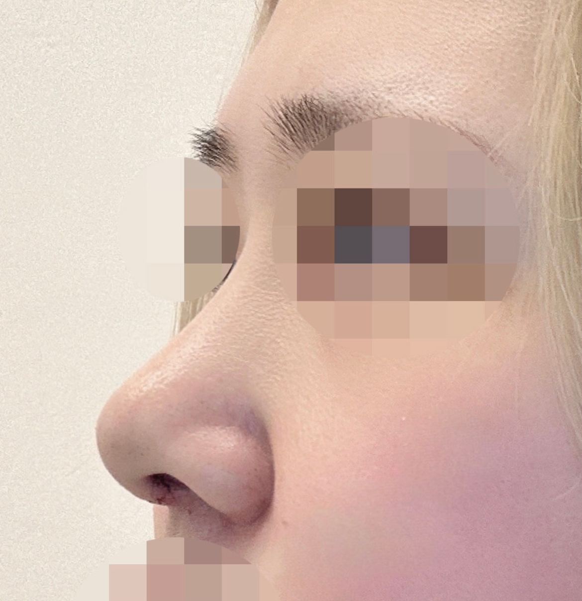 수술후기이미지