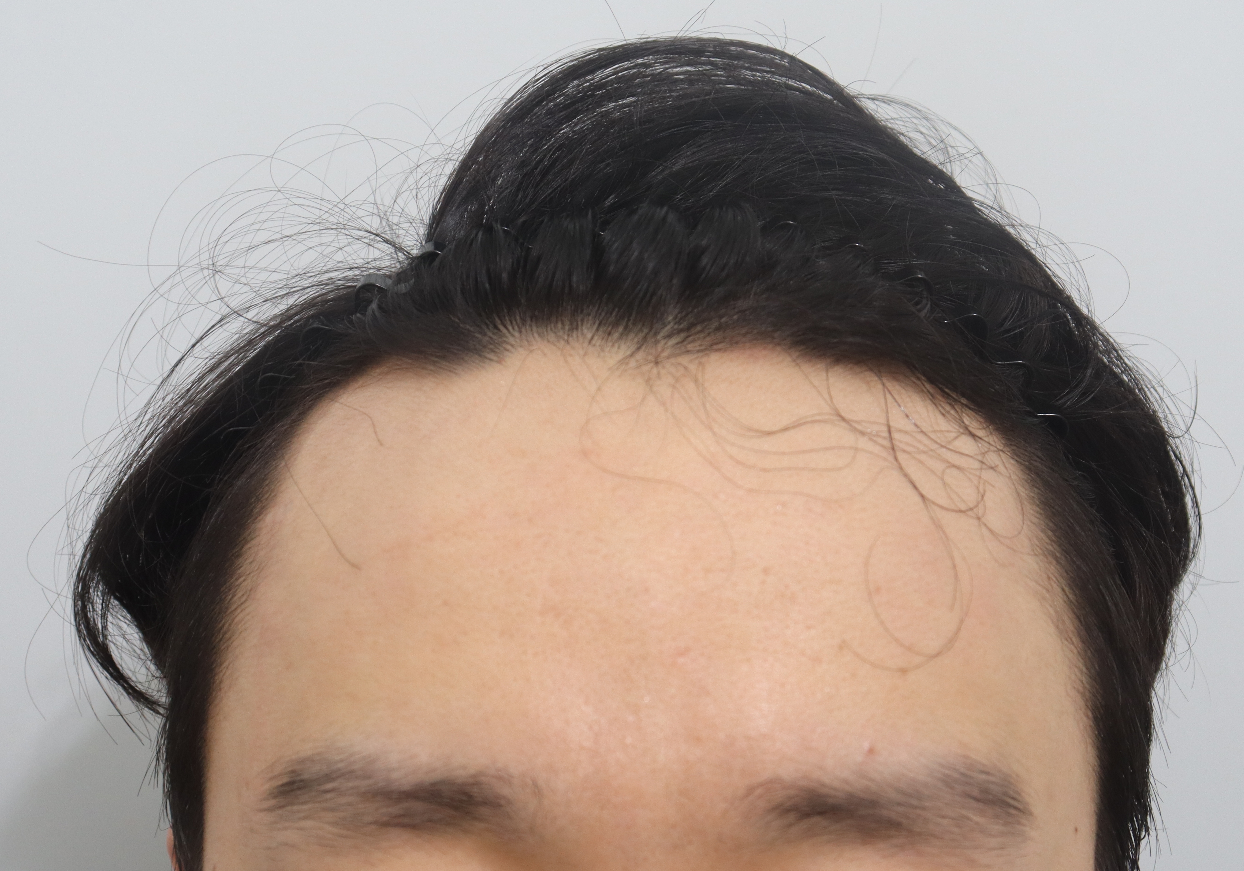 수술후기이미지