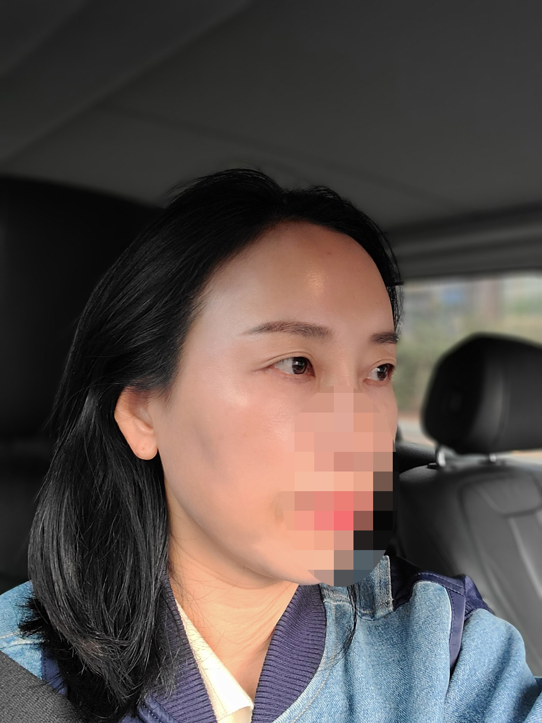 수술후기이미지