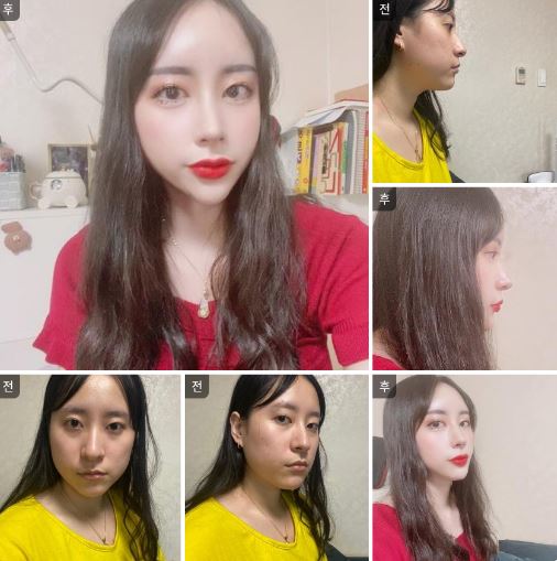 수술후기이미지