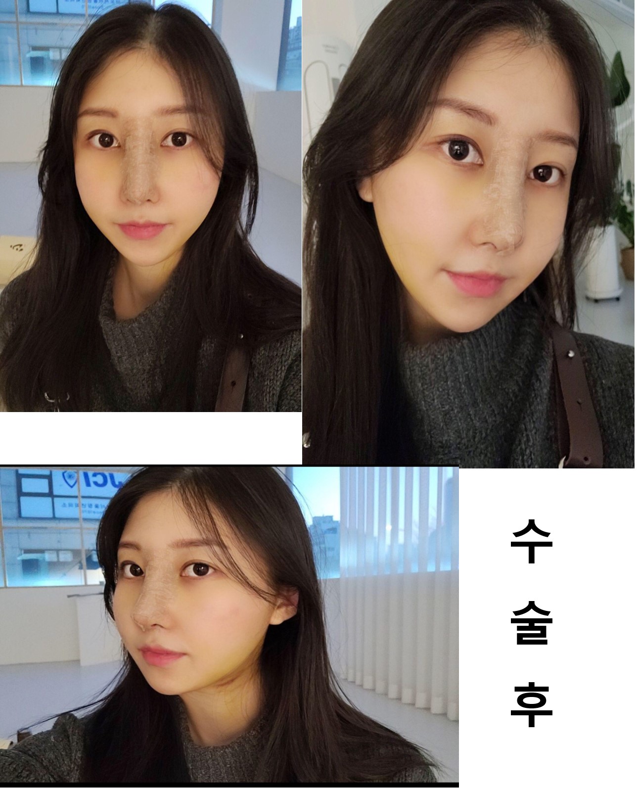 수술후기이미지