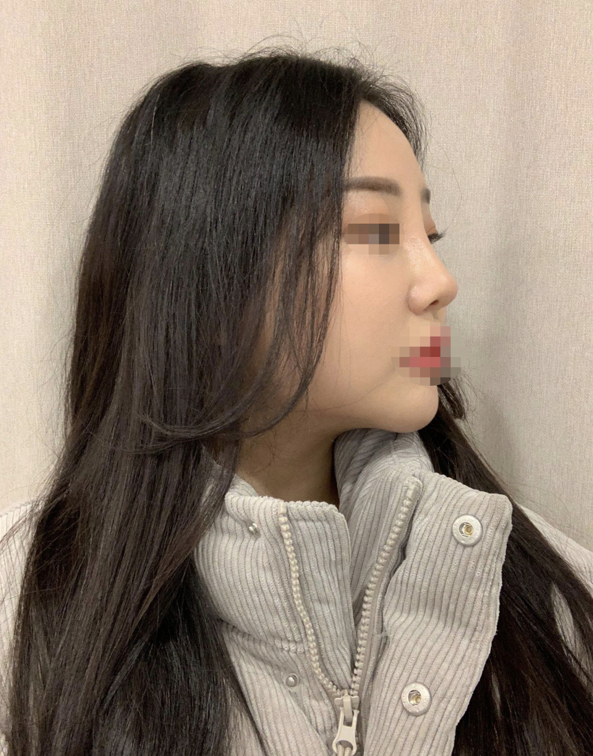 수술후기이미지