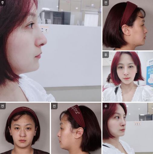 수술후기이미지