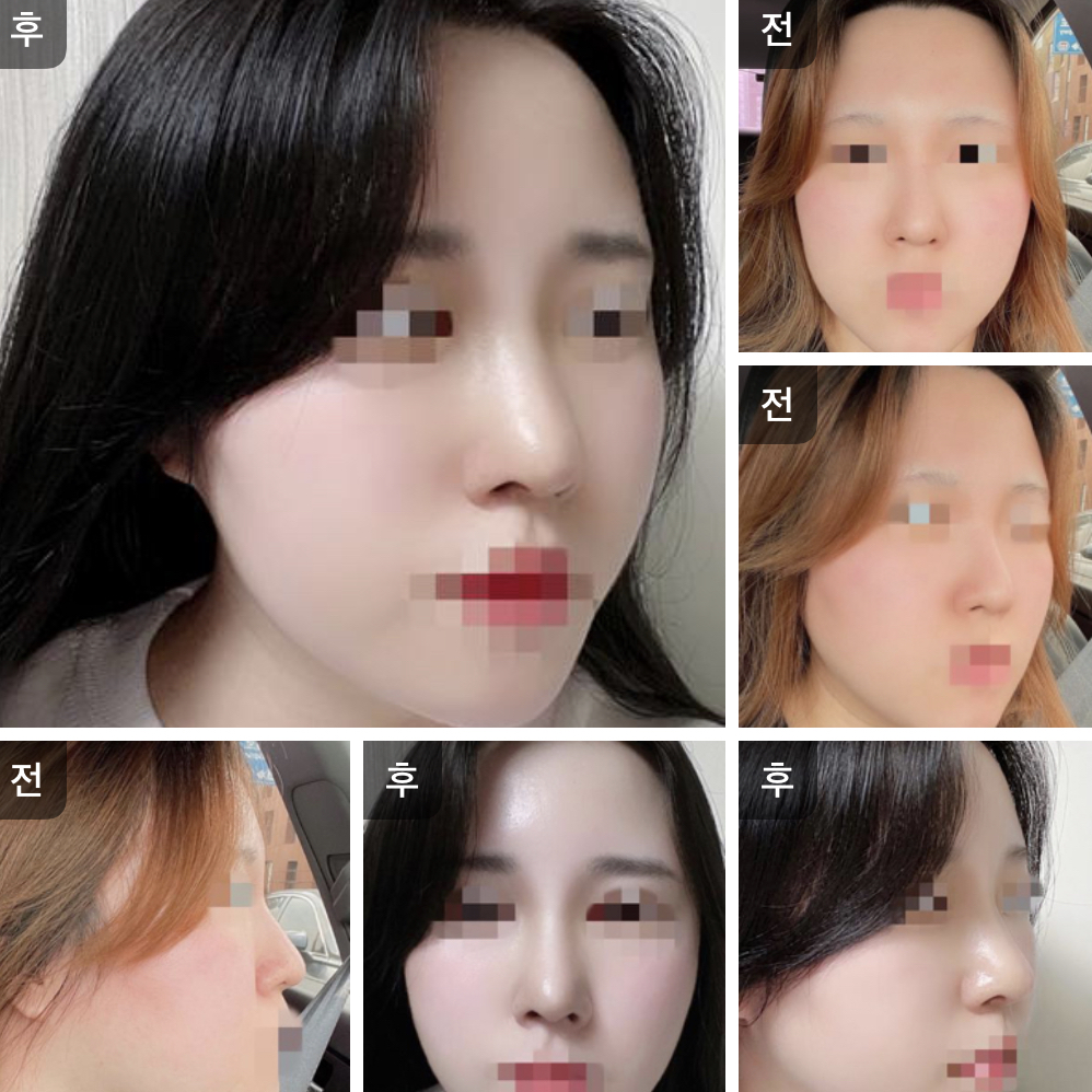 수술후기이미지