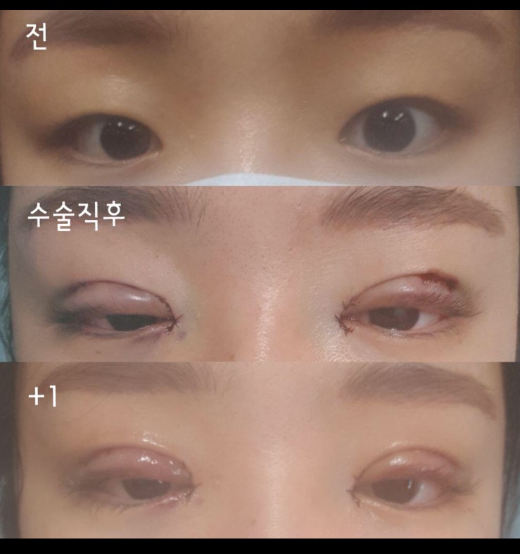 수술후기이미지