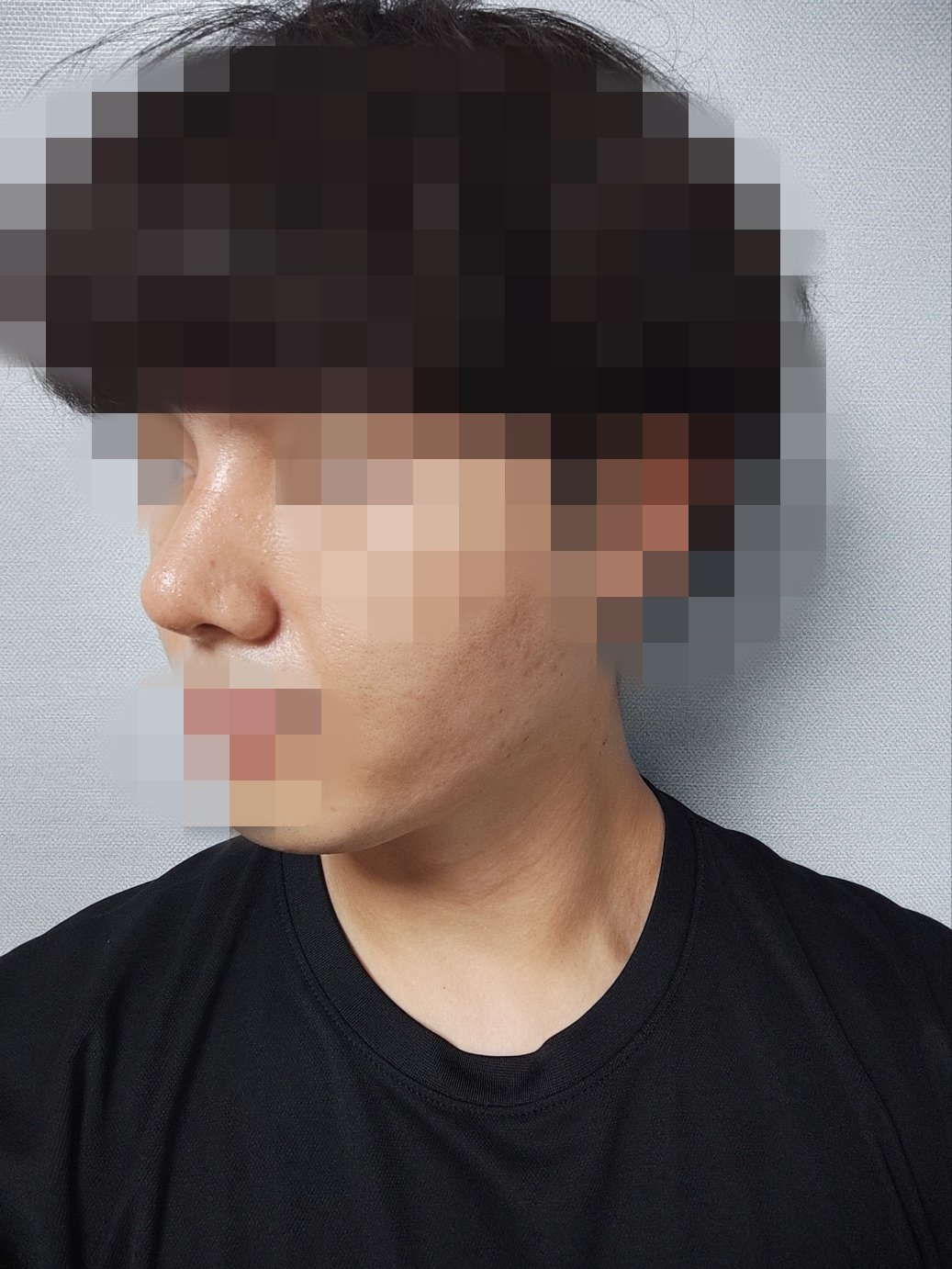 수술후기이미지