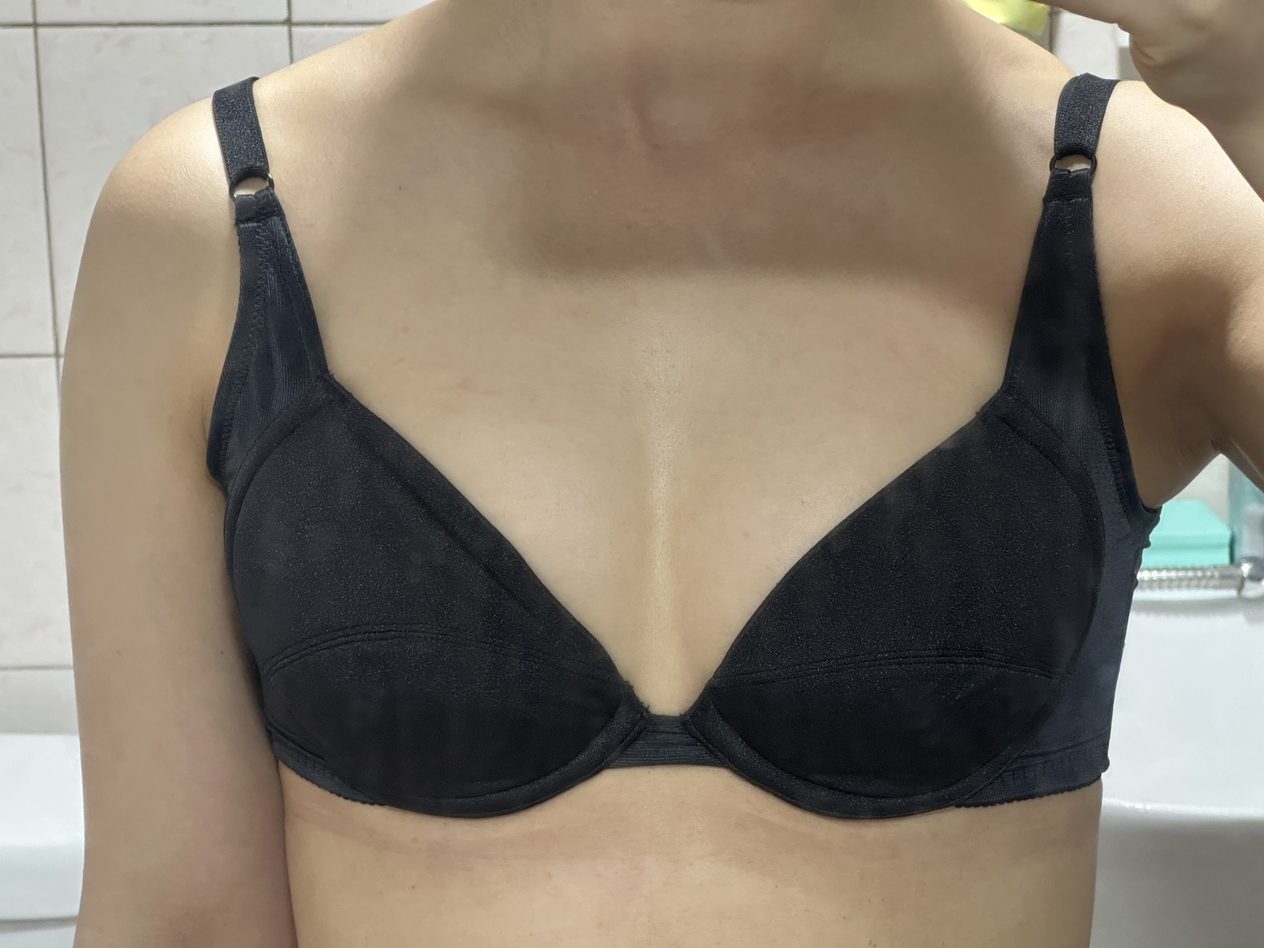 벌써 일상생활이 편해졌어요 만족스러운 가슴지방이식 한 달차 입니다ㅎㅎ