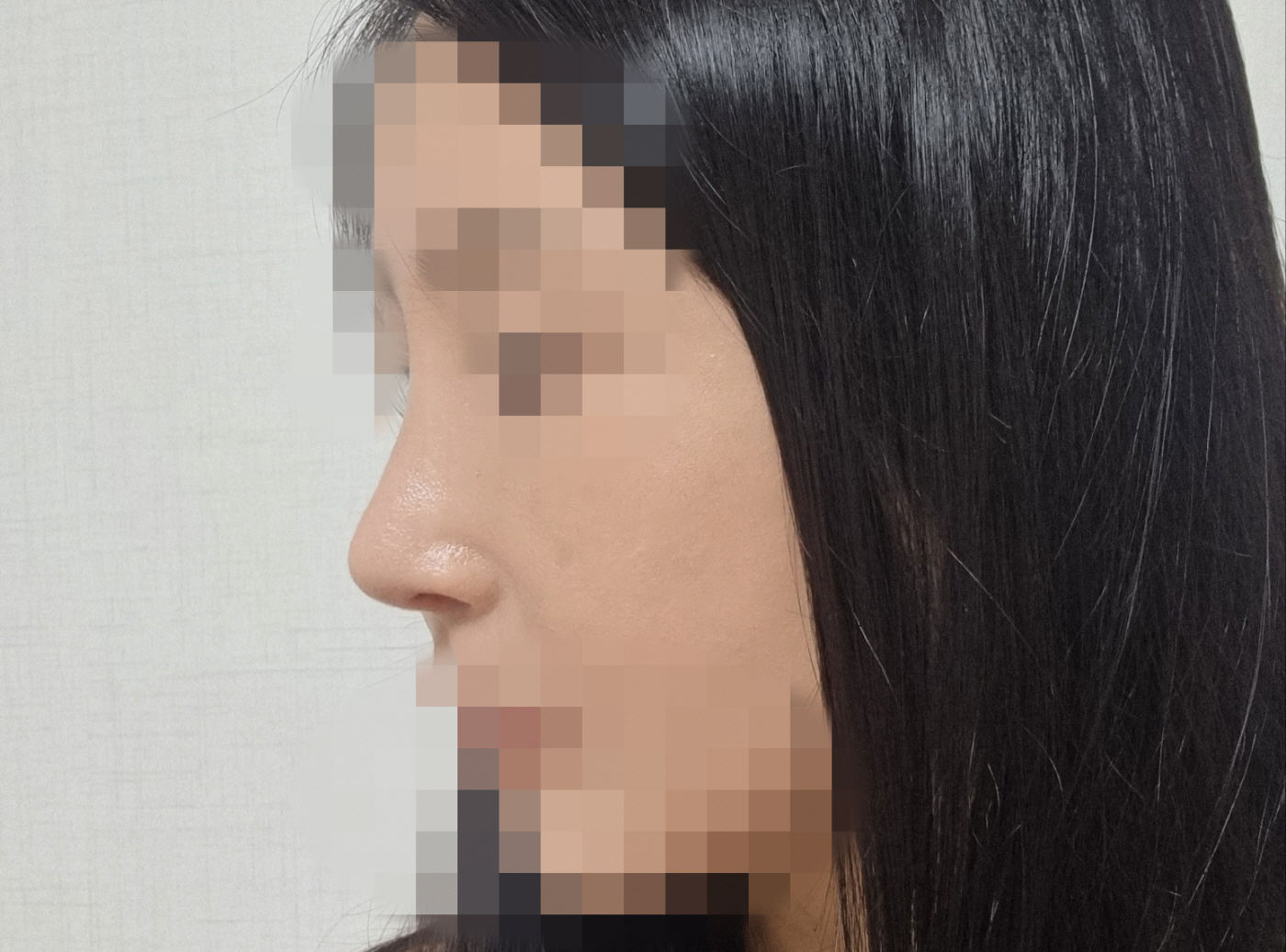 수술후기이미지