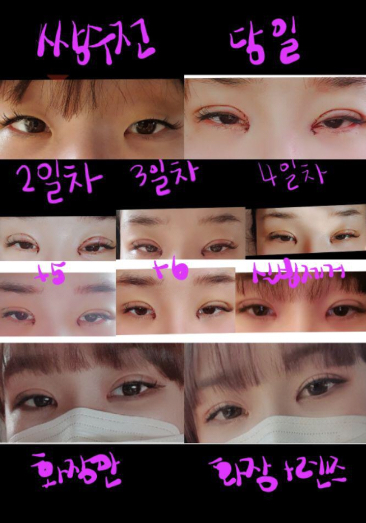 수술후기이미지