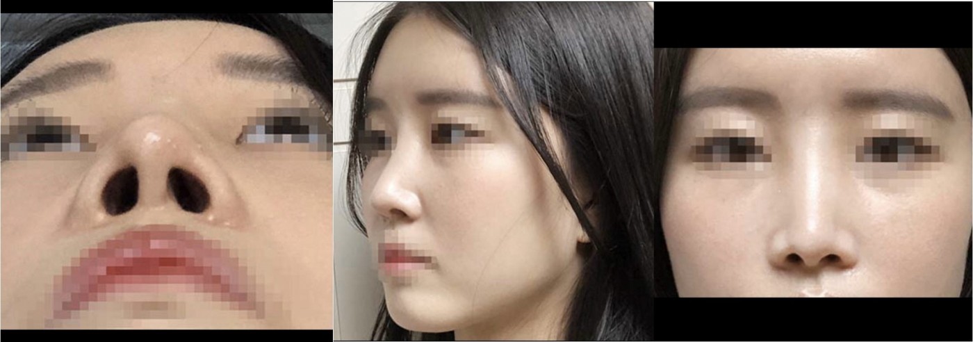 수술후기이미지