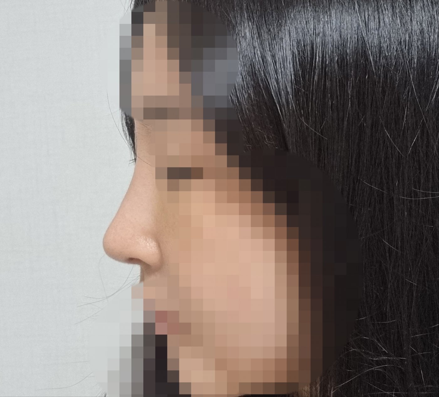 수술후기이미지