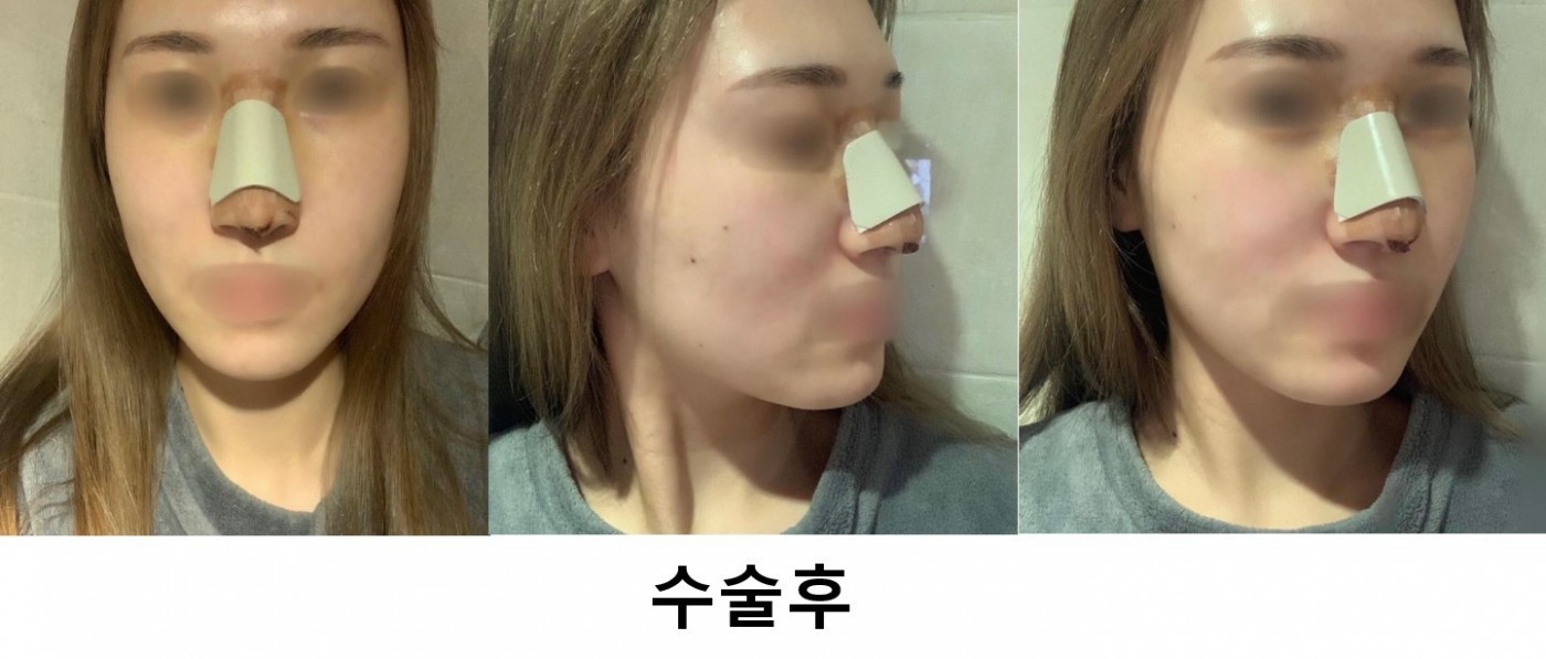 수술후기이미지