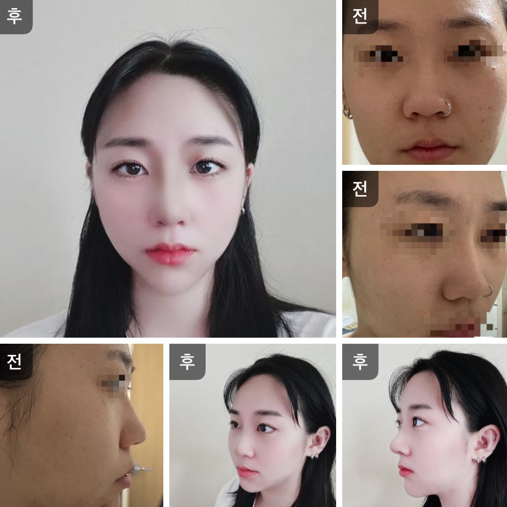 수술후기이미지