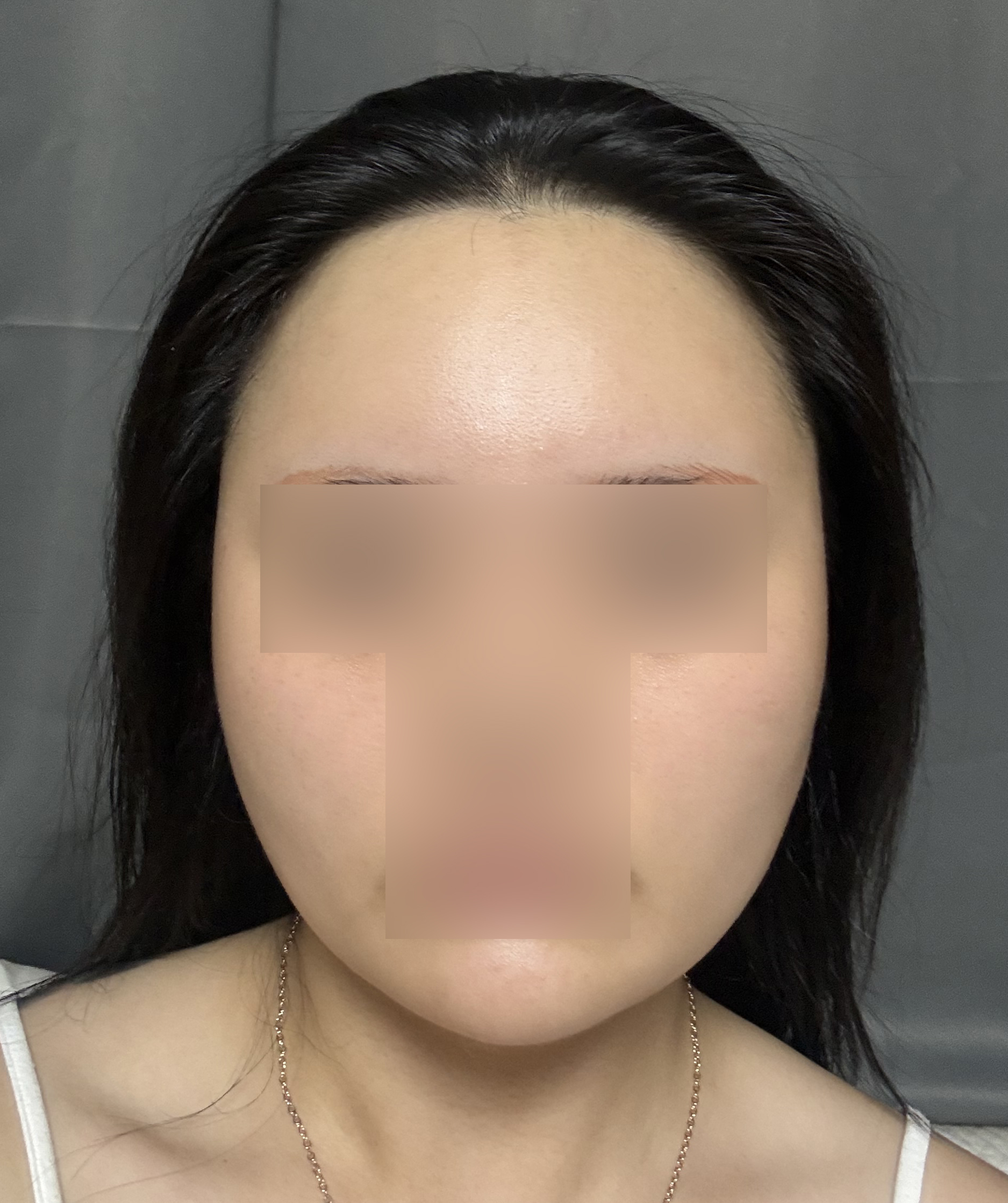 수술 전과 비교하니 확실히 달라진 턱라인이에요~