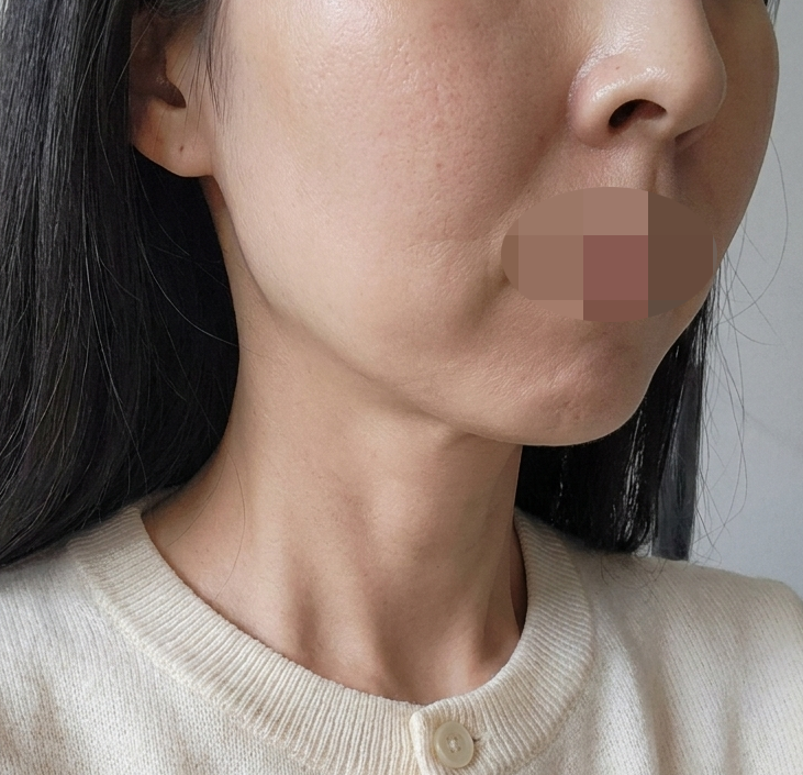 수술후기이미지