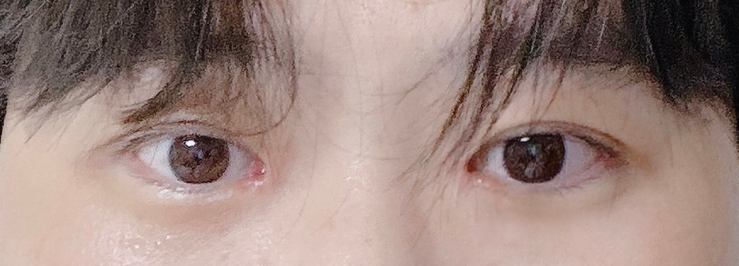 수술후기이미지