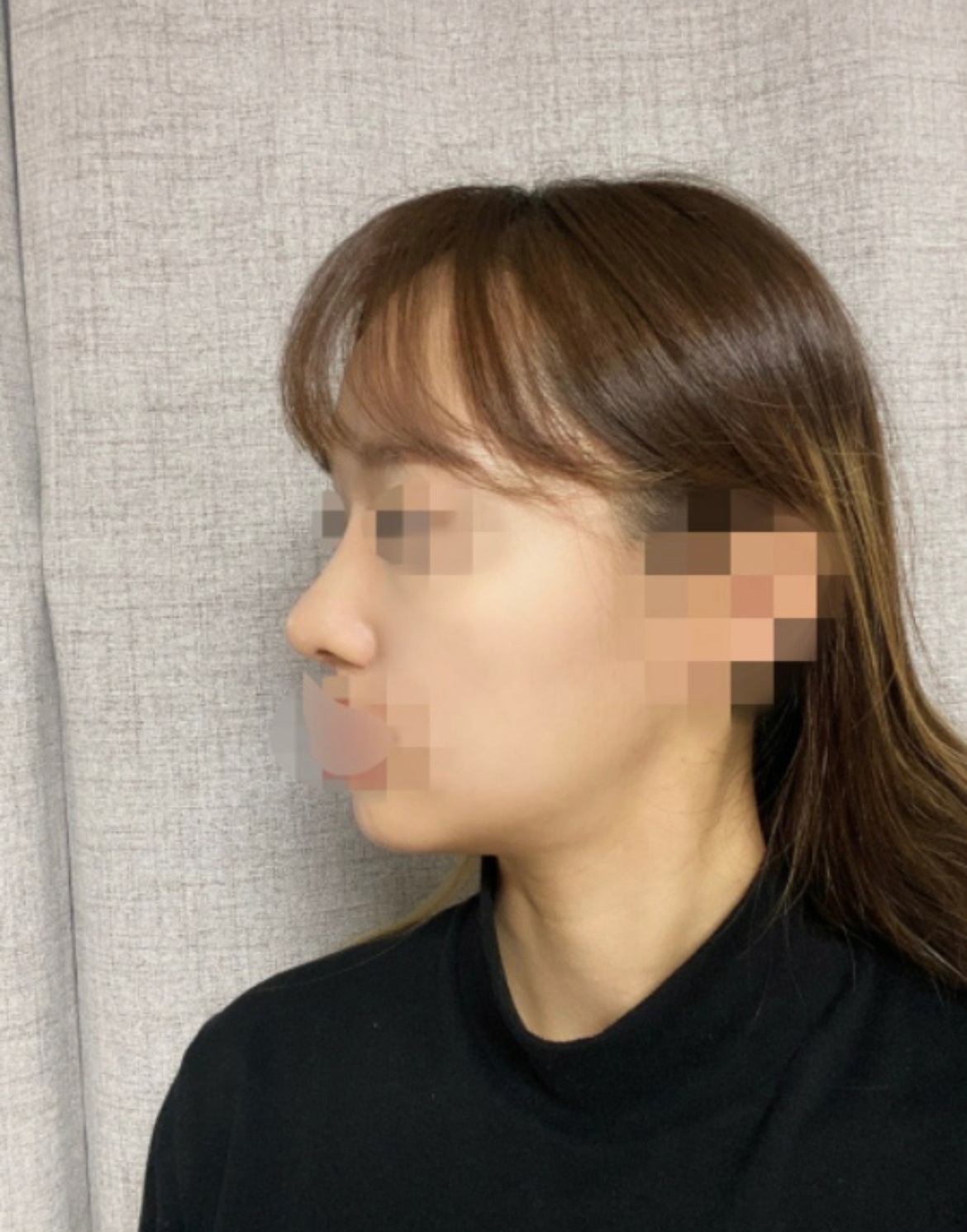 수술후기이미지