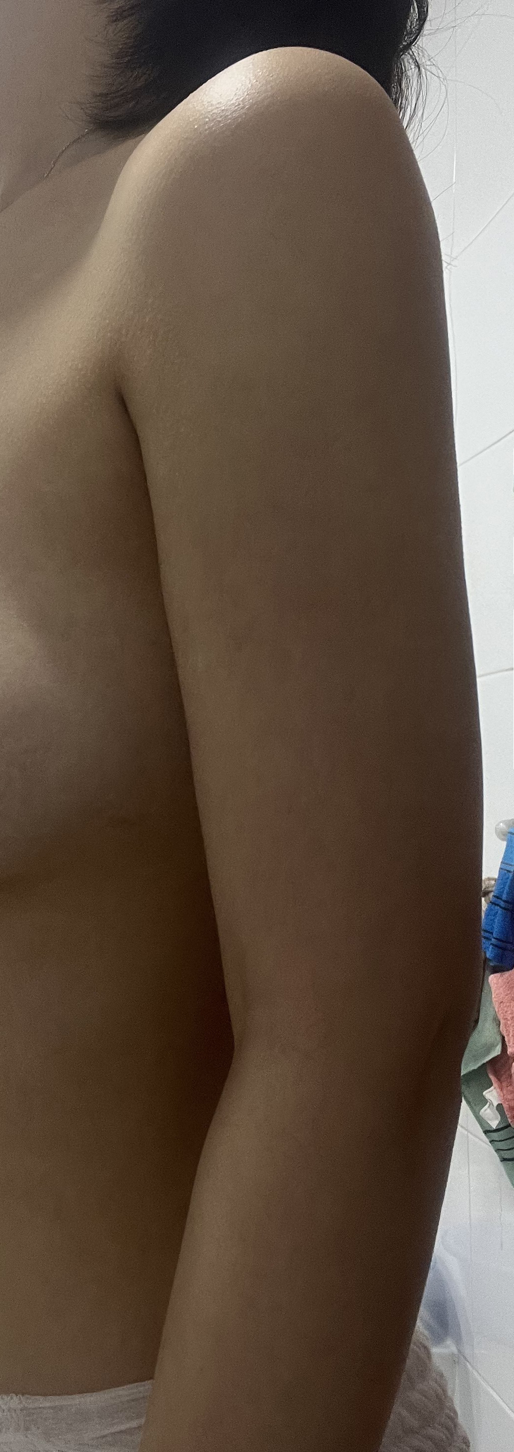 팔지방흡입 2달차, 회복될수록 만족스러워요