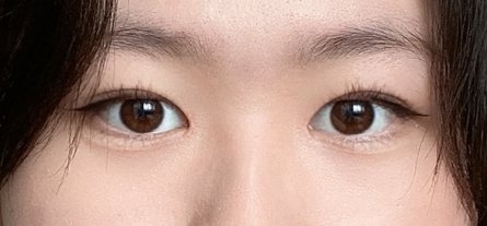 수술후기이미지