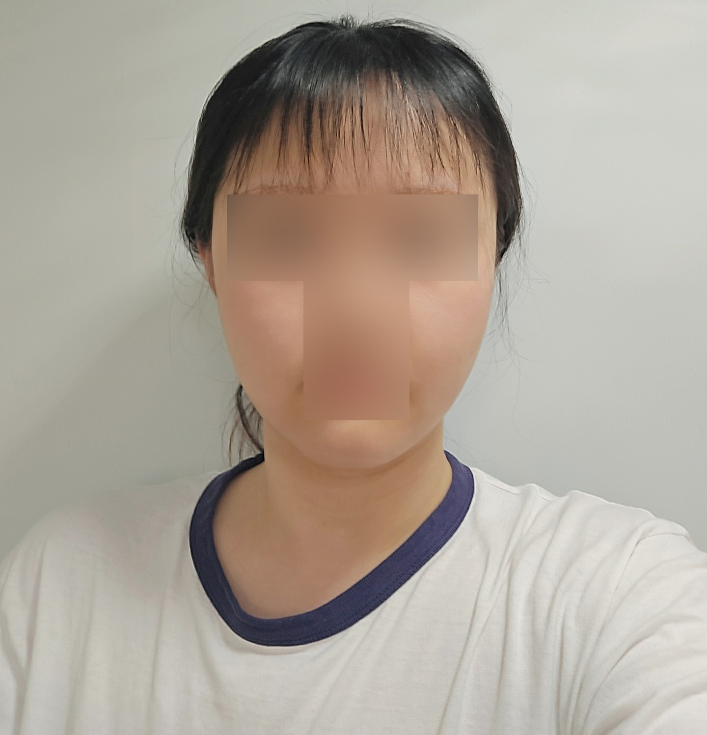수술후기이미지