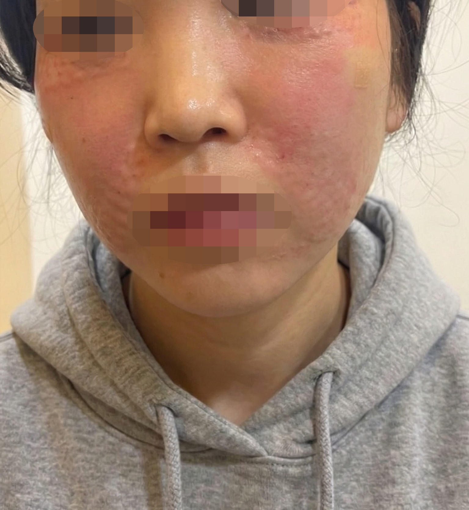 수술후기이미지