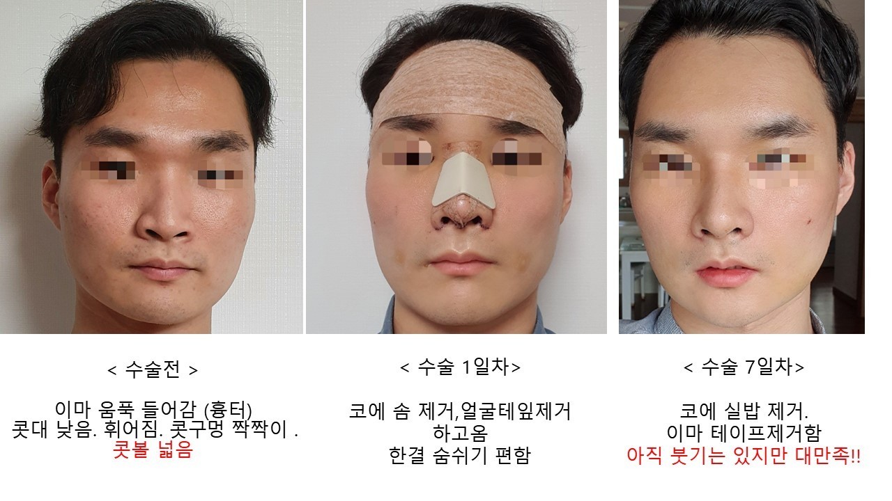 수술후기이미지