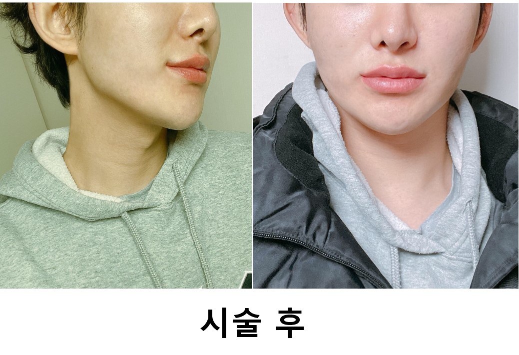 수술후기이미지