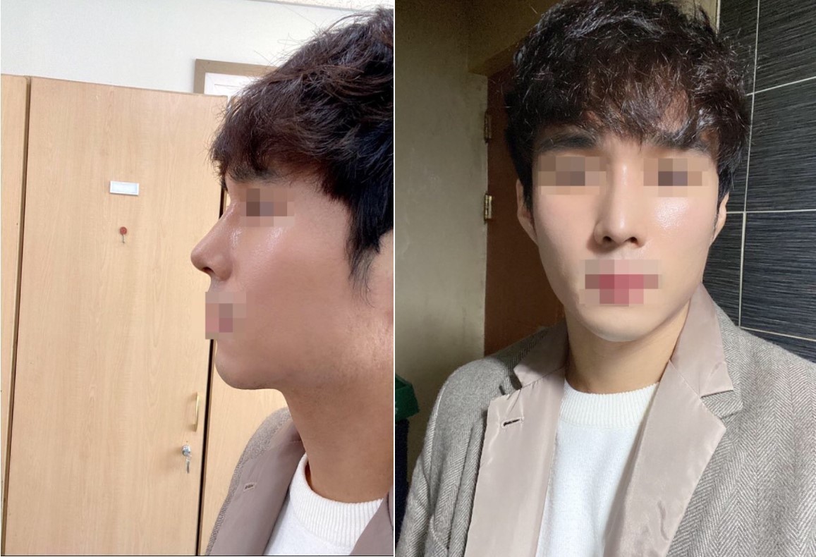 수술후기이미지