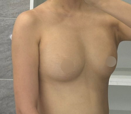 가슴지방이식 4개월! 자연스러운 볼륨에 만족해요^^