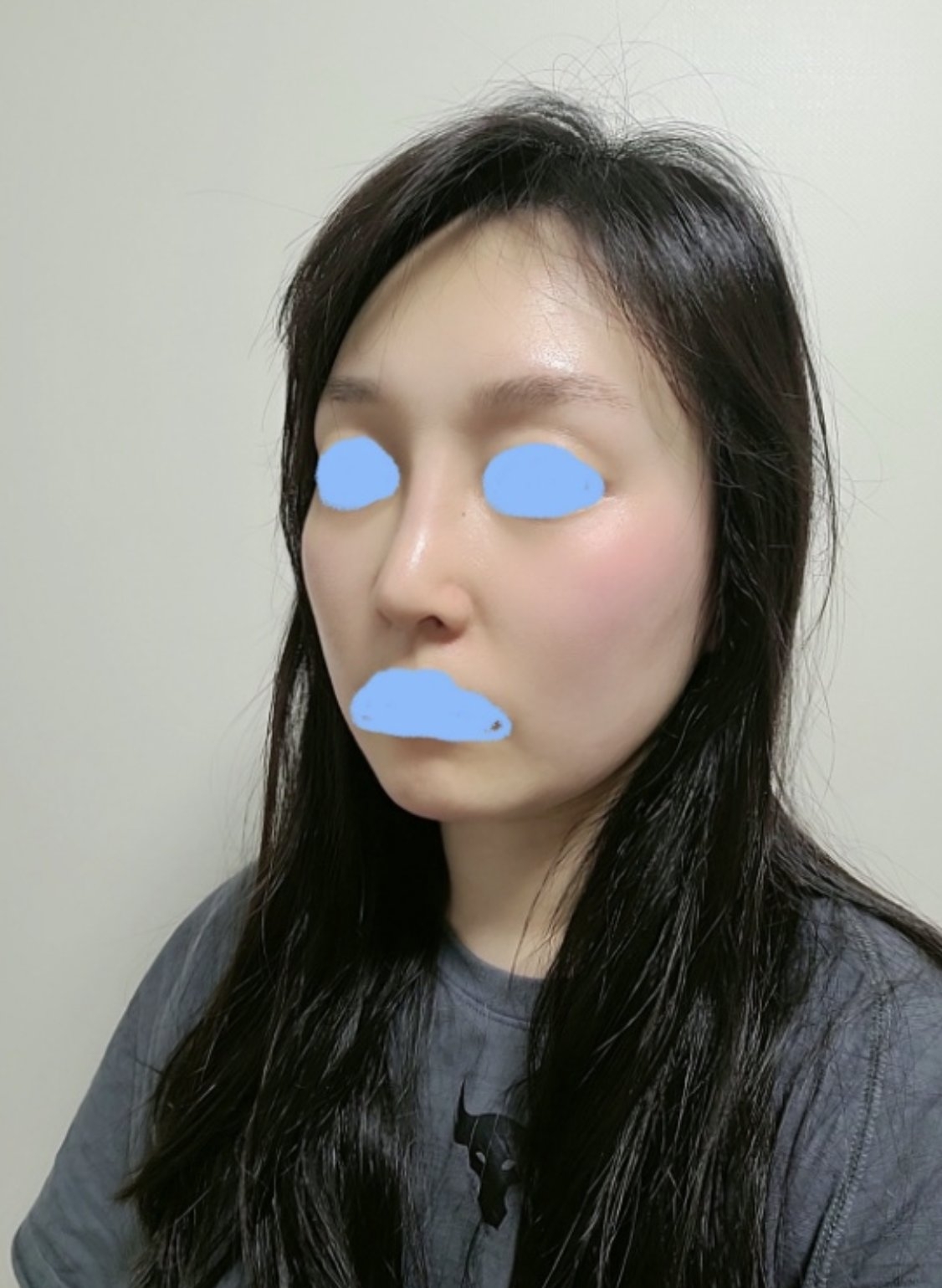 수술후기이미지