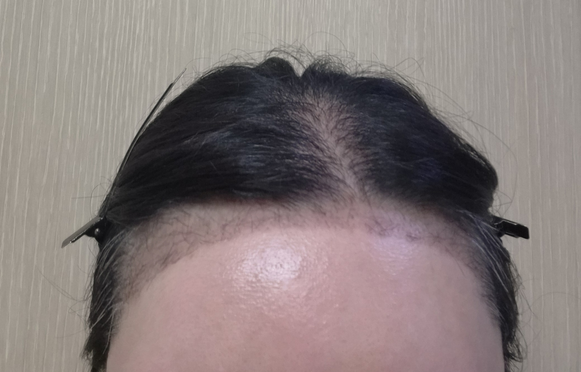 수술후기이미지