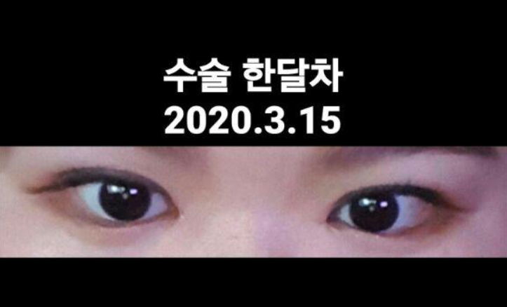 수술후기이미지