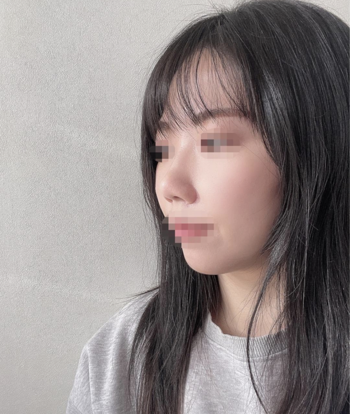 수술후기이미지