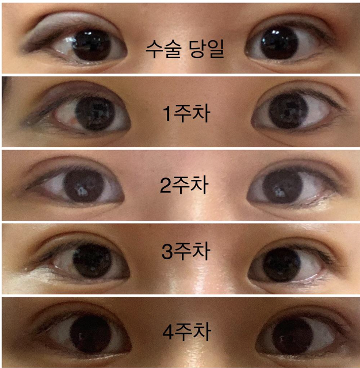 수술후기이미지