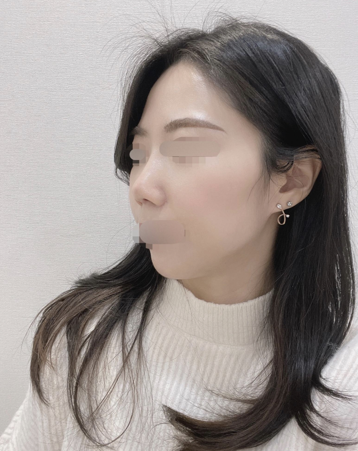 수술후기이미지