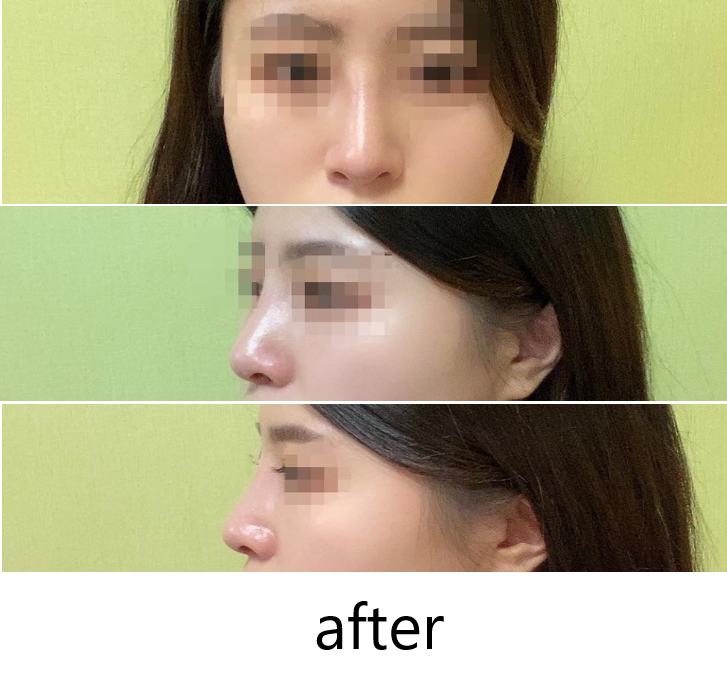 수술후기이미지