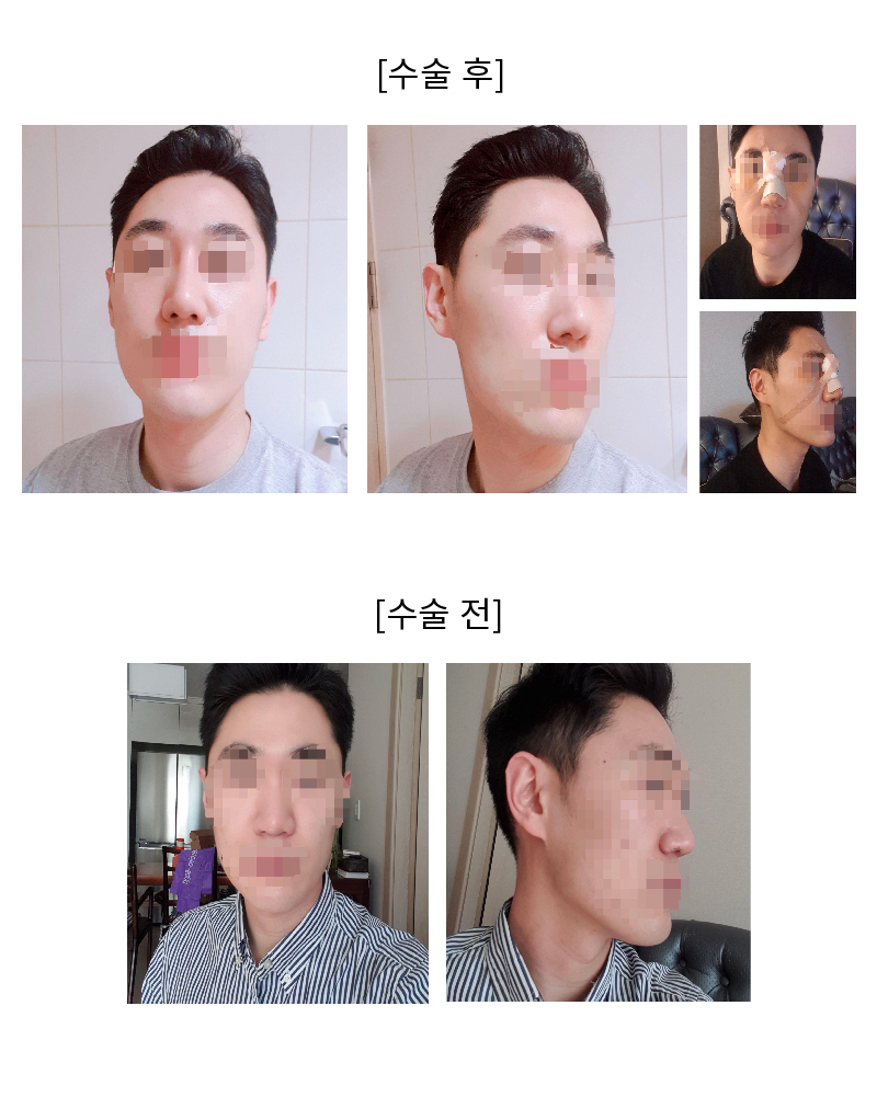 수술후기이미지