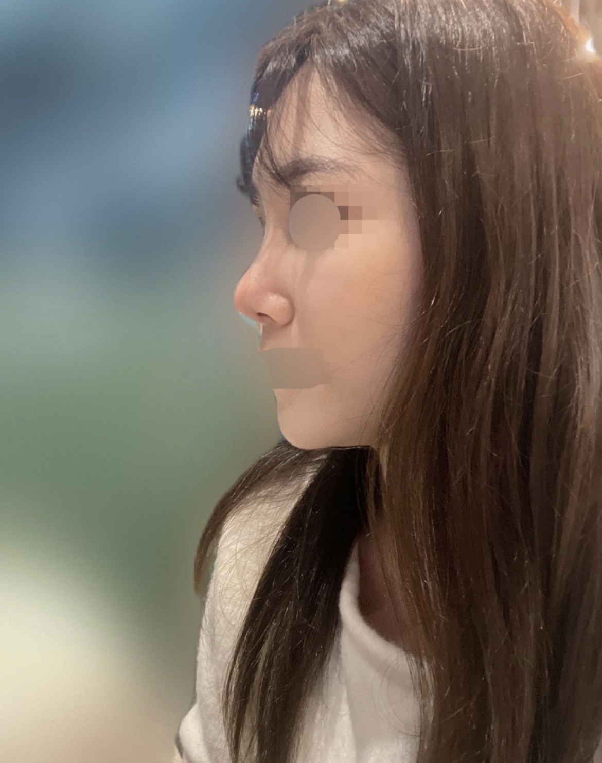 수술후기이미지