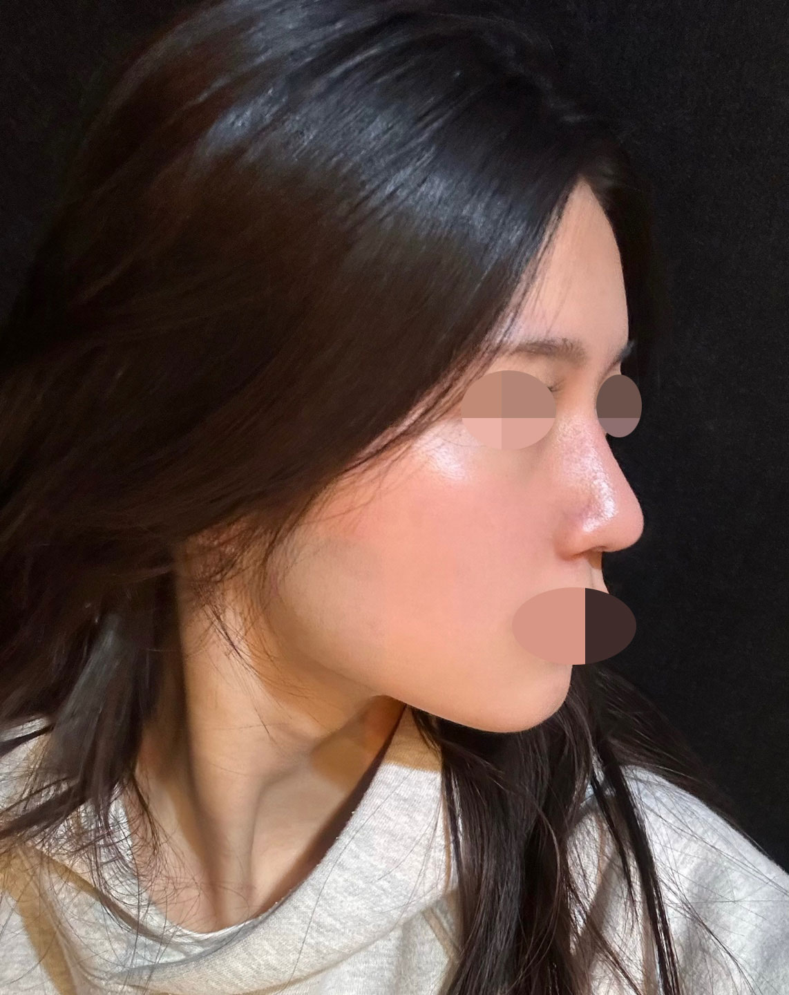 수술후기이미지