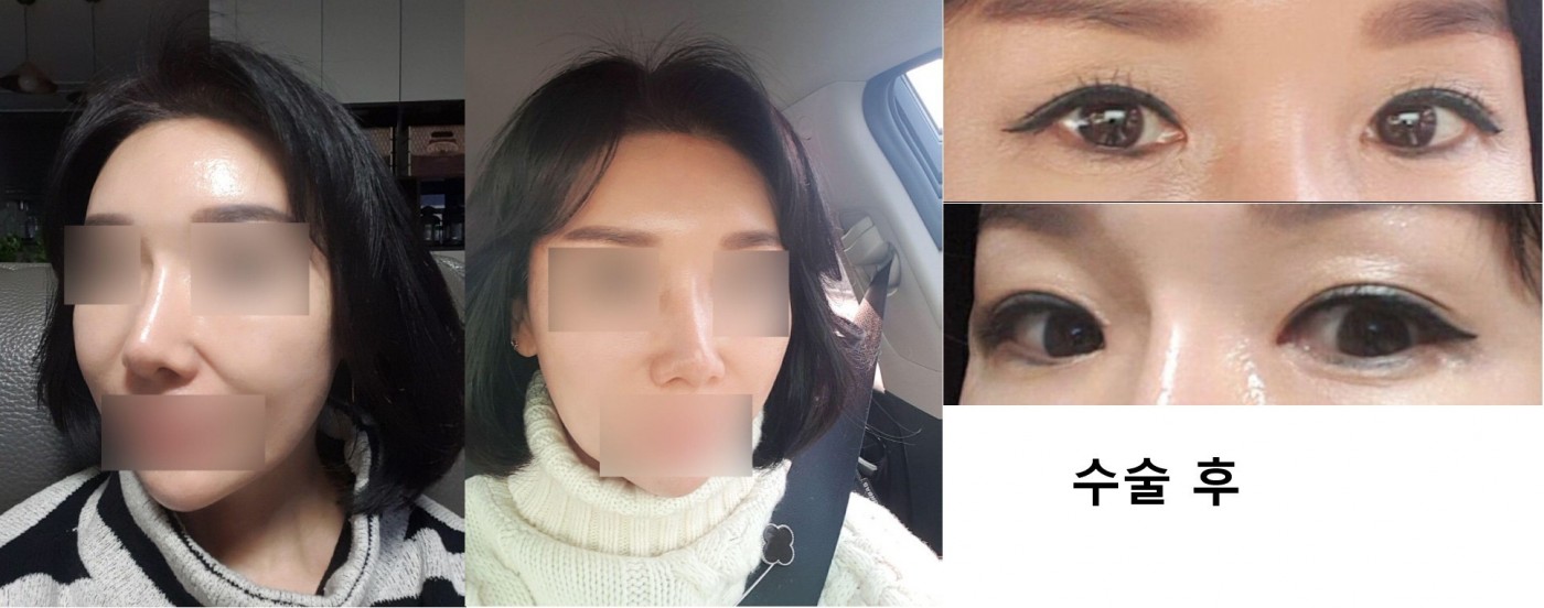 수술후기이미지