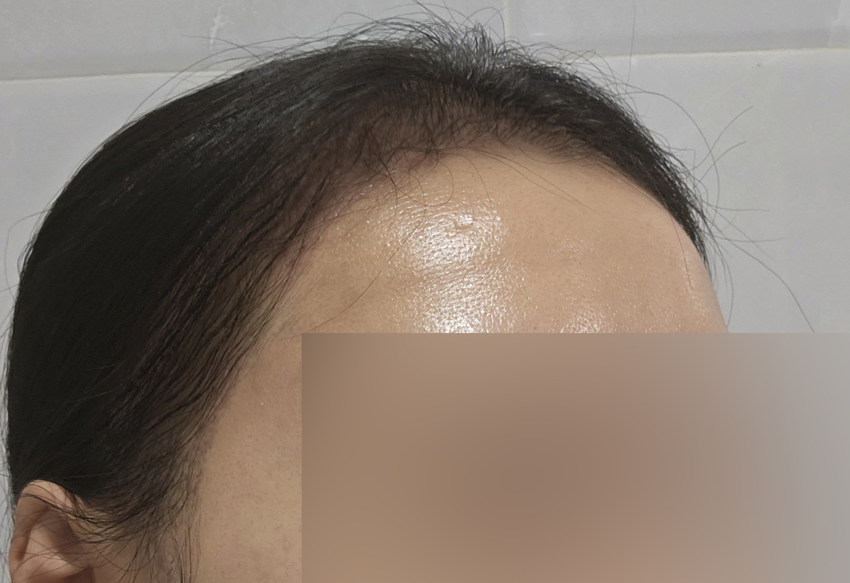 수술후기이미지