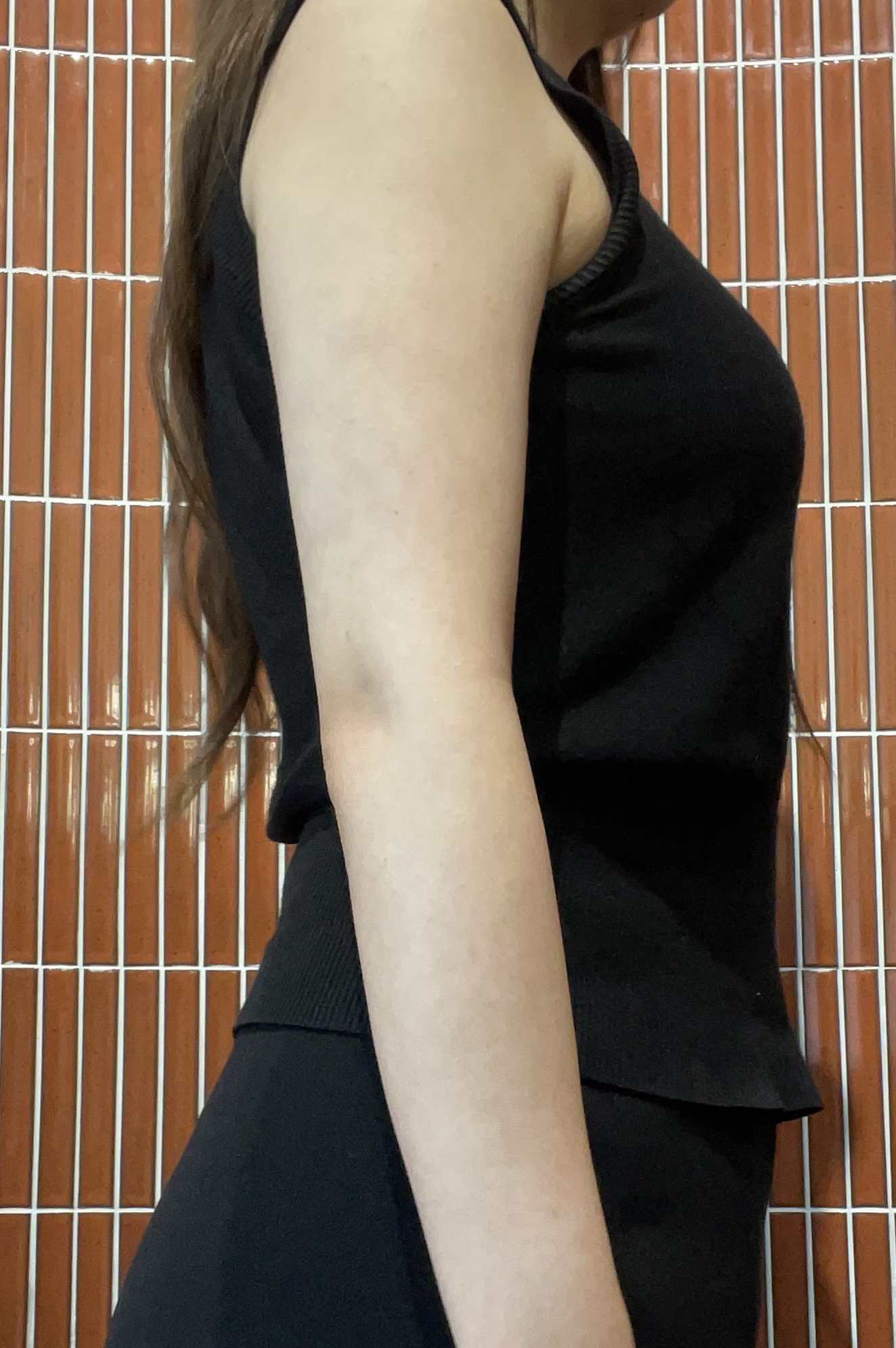 팔지방흡입 3달차, 비포 애프터 차이가 확실해요