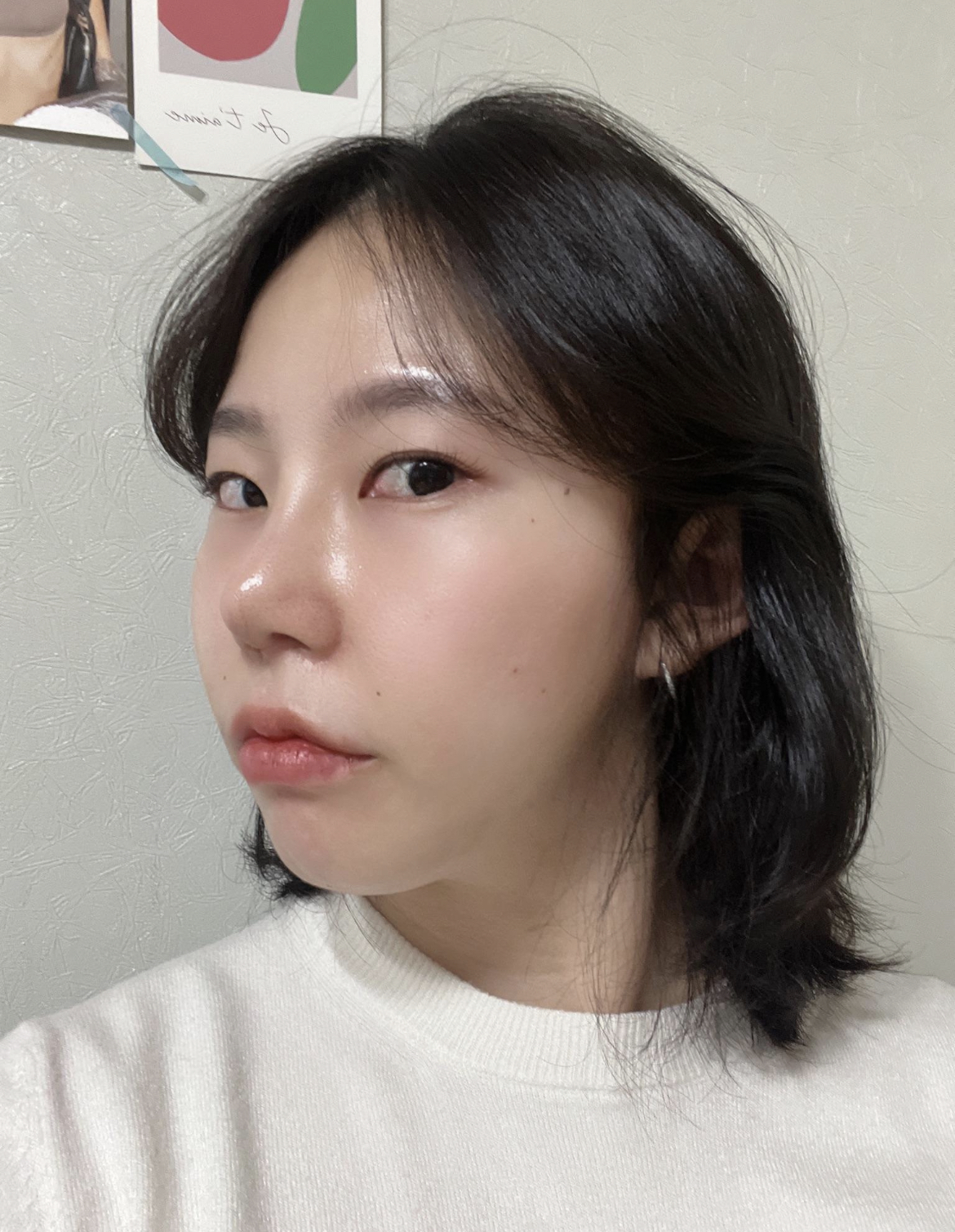 수술후기이미지