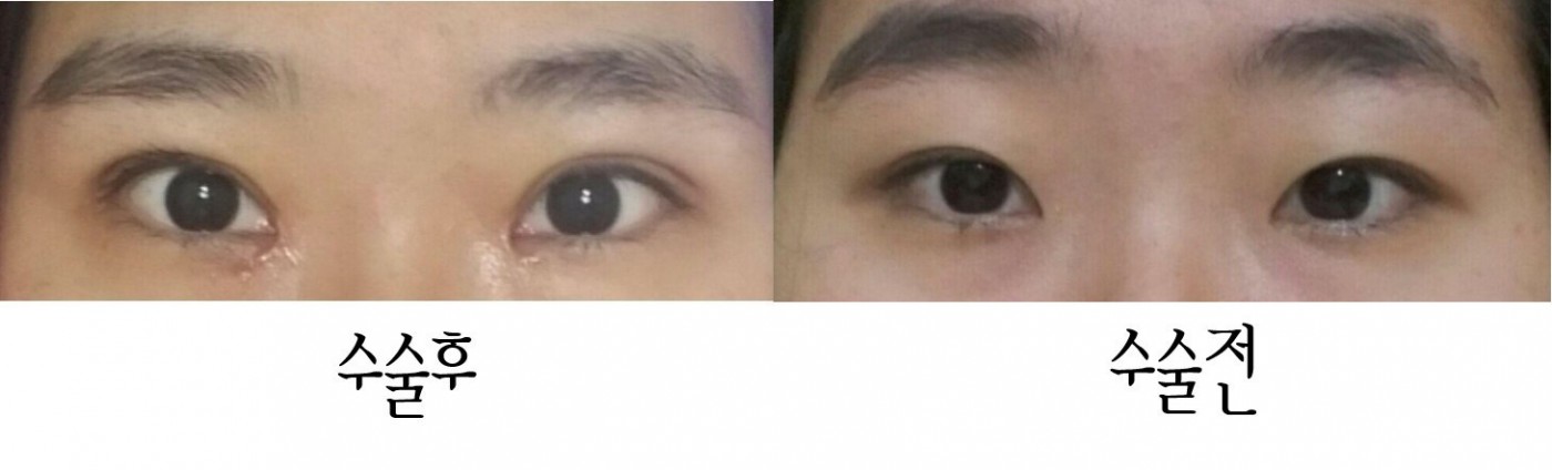 수술후기이미지