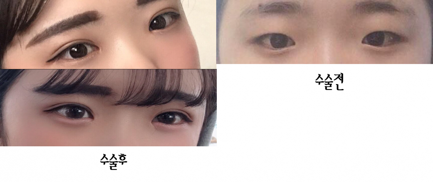 수술후기이미지