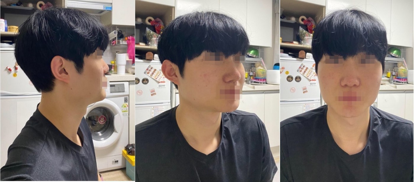 수술후기이미지