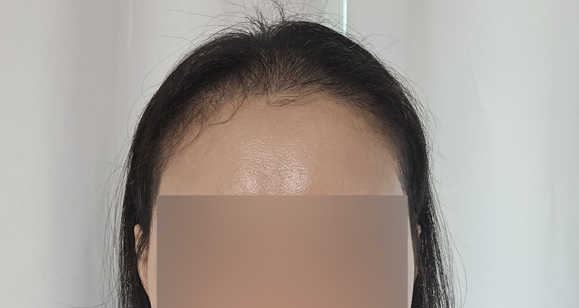 수술후기이미지
