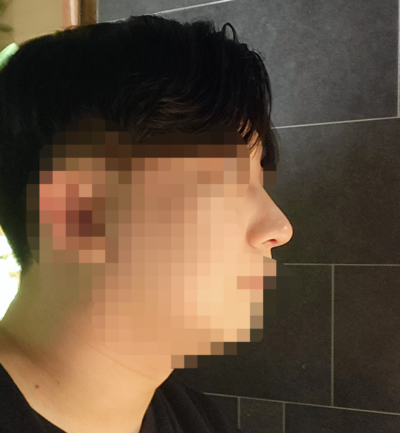 수술후기이미지